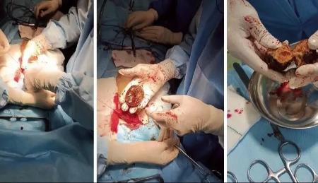 خرمالو،اخبار پزشکی،خبرهای پزشکی