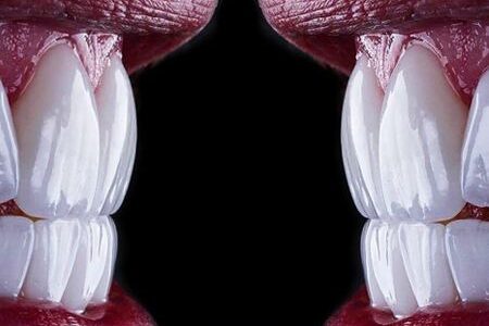 لمینت برای چه دندان هایی مناسب نیست؟ (بررسی 6 مورد ممنوعه + جایگزین‌ها)